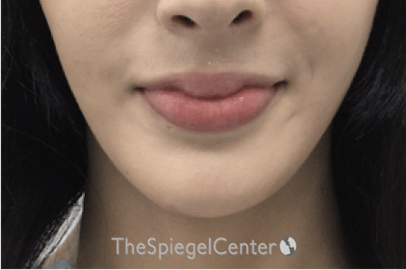 Mandible Contouring Before & After Gallery - Patient 360298 - Image 2