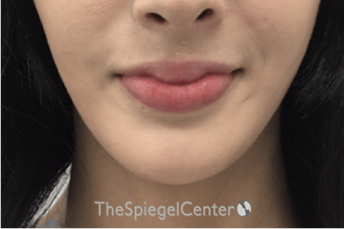 FFS Mandible Contouring Before & After Gallery - Patient 271524 - Image 2