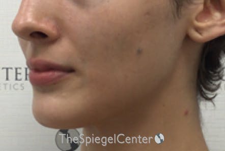 FFS Mandible Contouring Before & After Gallery - Patient 271524 - Image 3