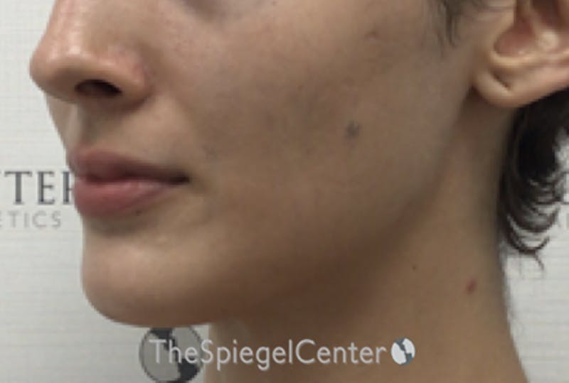 Mandible Contouring Before & After Gallery - Patient 360298 - Image 3