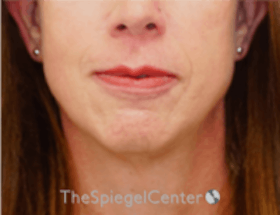 FFS Mandible Contouring Before & After Gallery - Patient 579268 - Image 1