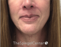 FFS Mandible Contouring Before & After Gallery - Patient 579268 - Image 2