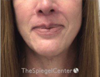 Mandible Contouring Before & After Gallery - Patient 222136 - Image 2