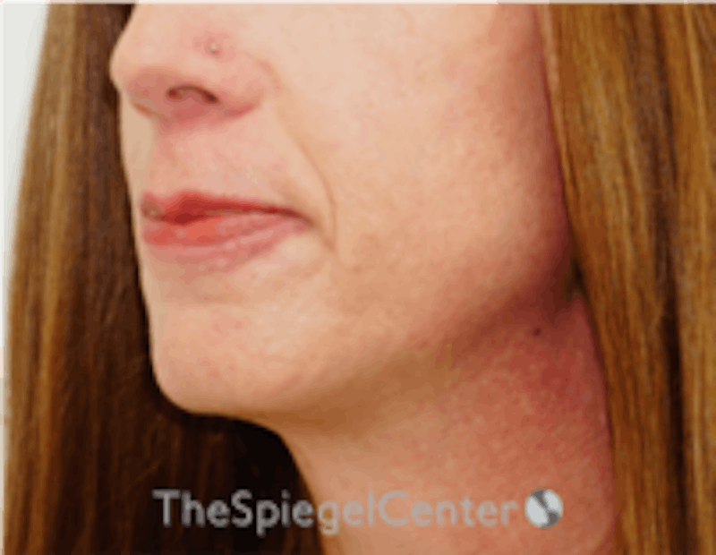 Mandible Contouring Before & After Gallery - Patient 222136 - Image 3