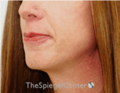 FFS Mandible Contouring Before & After Gallery - Patient 579268 - Image 3