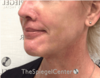 Mandible Contouring Before & After Gallery - Patient 222136 - Image 4
