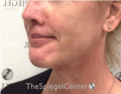 FFS Mandible Contouring Before & After Gallery - Patient 579268 - Image 4
