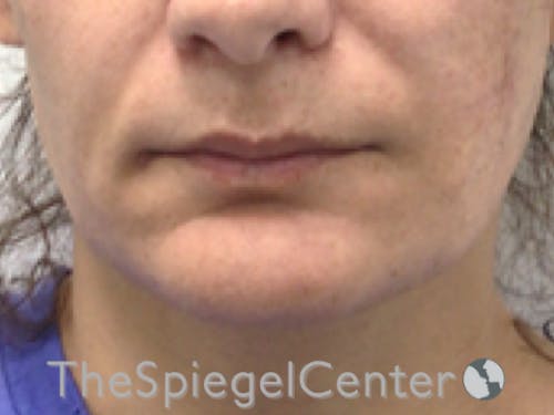 FFS Mandible Contouring Before & After Gallery - Patient 384553 - Image 1