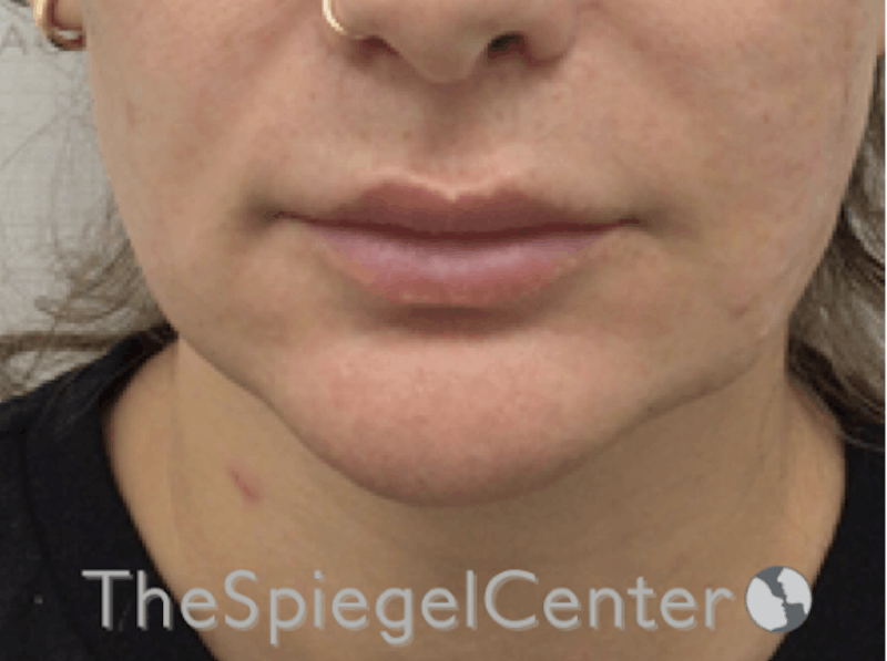 Mandible Contouring Before & After Gallery - Patient 277599 - Image 2