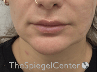 Mandible Contouring Before & After Gallery - Patient 277599 - Image 2