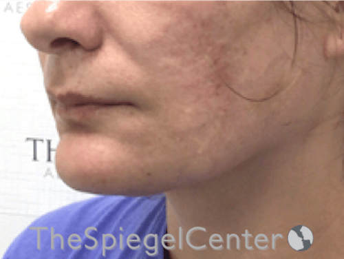 FFS Mandible Contouring Before & After Gallery - Patient 384553 - Image 3