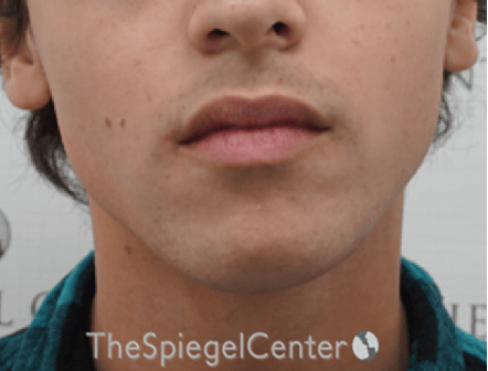 Mandible Contouring Before & After Gallery - Patient 709329 - Image 1