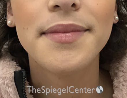 Mandible Contouring Before & After Gallery - Patient 709329 - Image 2