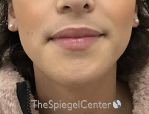 FFS Mandible Contouring Before & After Gallery - Patient 188056 - Image 2