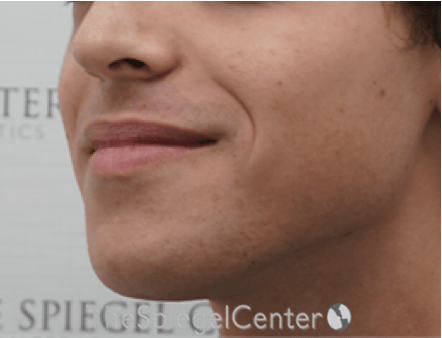 Mandible Contouring Before & After Gallery - Patient 709329 - Image 3