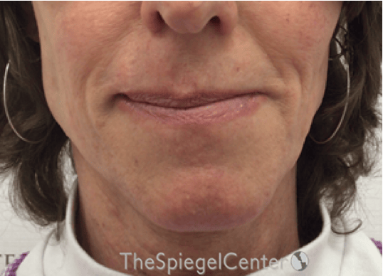 FFS Mandible Contouring Before & After Gallery - Patient 318398 - Image 1