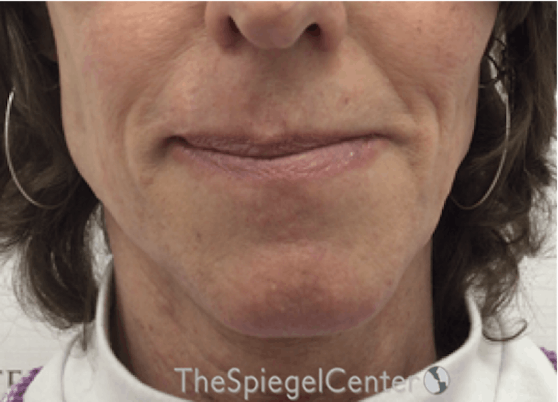 Mandible Contouring Before & After Gallery - Patient 301199 - Image 1