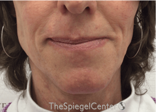 FFS Mandible Contouring Before & After Gallery - Patient 318398 - Image 1