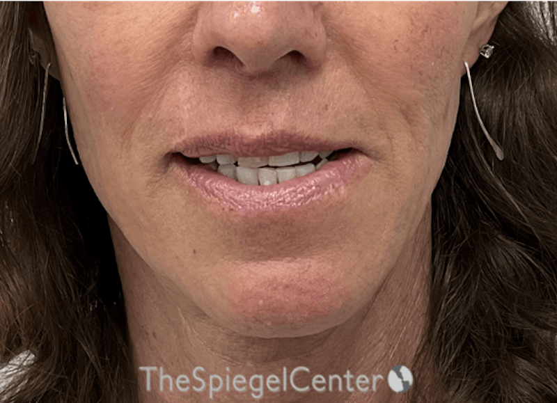 Mandible Contouring Before & After Gallery - Patient 301199 - Image 2