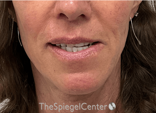 FFS Mandible Contouring Before & After Gallery - Patient 318398 - Image 2