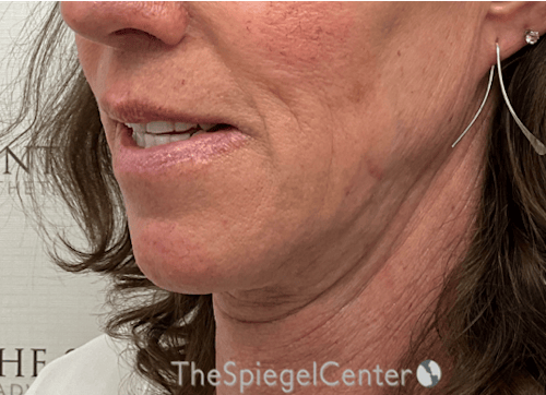 FFS Mandible Contouring Before & After Gallery - Patient 318398 - Image 4