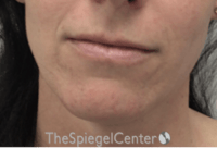 Mandible Contouring Before & After Gallery - Patient 167870 - Image 1