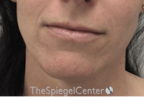 FFS Mandible Contouring Before & After Gallery - Patient 100411 - Image 1