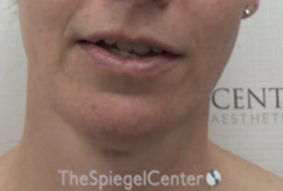 FFS Mandible Contouring Before & After Gallery - Patient 100411 - Image 2