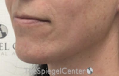 FFS Mandible Contouring Before & After Gallery - Patient 100411 - Image 3