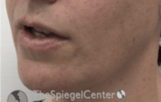 Mandible Contouring Before & After Gallery - Patient 167870 - Image 4