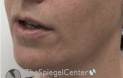 FFS Mandible Contouring Before & After Gallery - Patient 100411 - Image 4