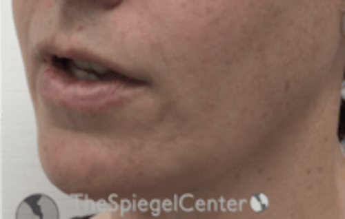 FFS Mandible Contouring Before & After Gallery - Patient 100411 - Image 4