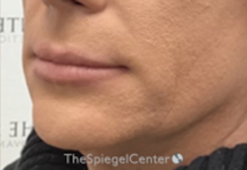Mandible Contouring Before & After Gallery - Patient 347722 - Image 1