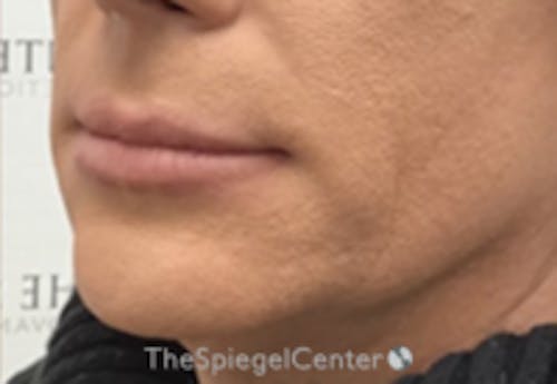 FFS Mandible Contouring Before & After Gallery - Patient 227499 - Image 1