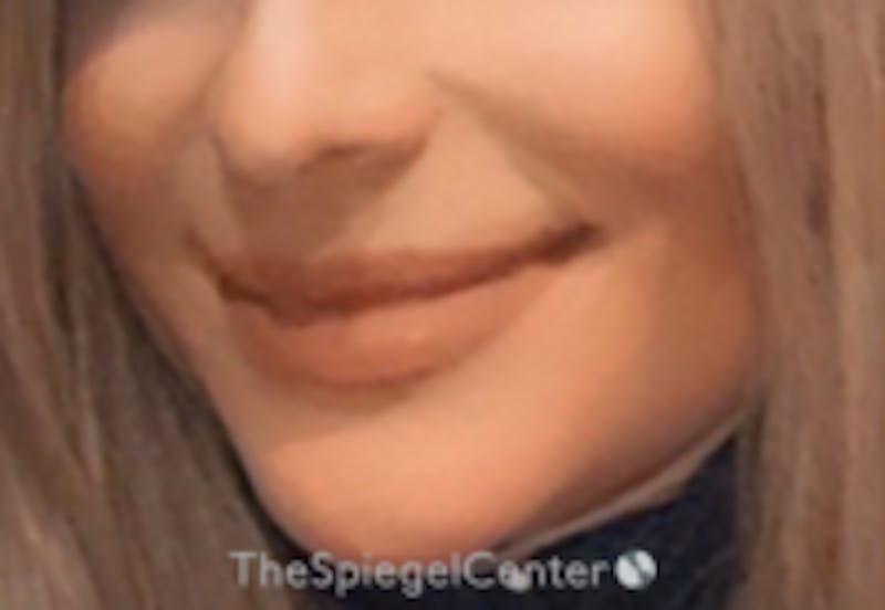 Mandible Contouring Before & After Gallery - Patient 347722 - Image 2