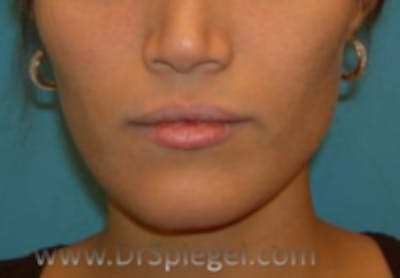 FFS Mandible Contouring Before & After Gallery - Patient 385555 - Image 1
