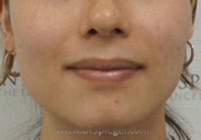 FFS Mandible Contouring Before & After Gallery - Patient 270804 - Image 1