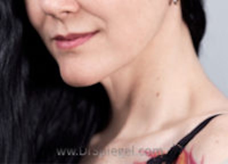Mandible Contouring Before & After Gallery - Patient 242138 - Image 2