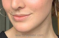 Mandible Contouring Before & After Gallery - Patient 316692 - Image 2