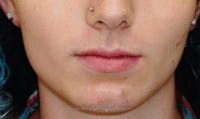 FFS Mandible Contouring Before & After Gallery - Patient 124028 - Image 1