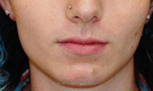 FFS Mandible Contouring Before & After Gallery - Patient 124028 - Image 1