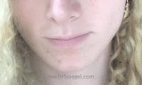 FFS Mandible Contouring Before & After Gallery - Patient 124028 - Image 2