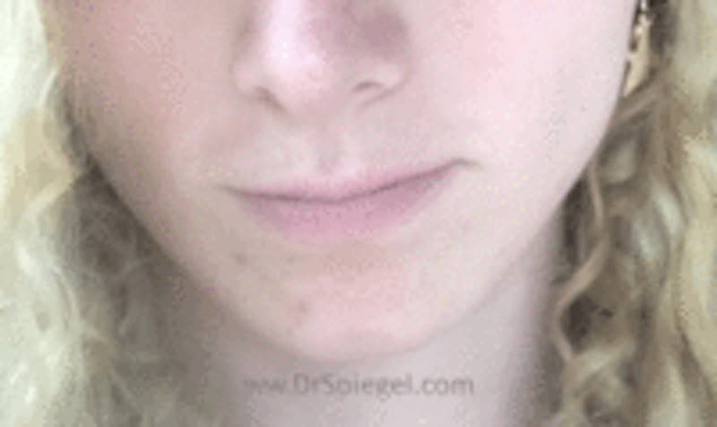 Mandible Contouring Before & After Gallery - Patient 577634 - Image 2