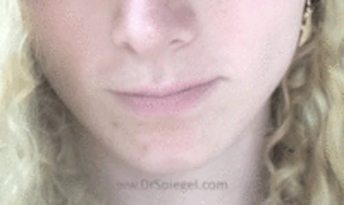 FFS Mandible Contouring Before & After Gallery - Patient 124028 - Image 2