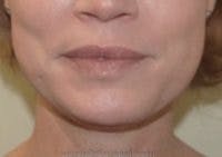 FFS Mandible Contouring Before & After Gallery - Patient 119472 - Image 1
