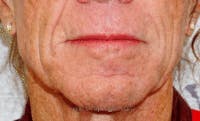 Mandible Contouring Before & After Gallery - Patient 398576 - Image 1
