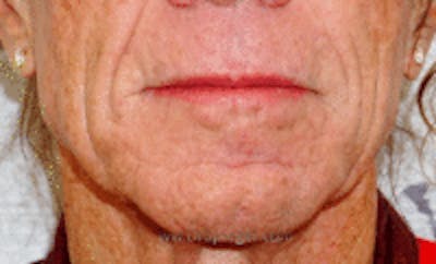 FFS Mandible Contouring Before & After Gallery - Patient 394947 - Image 1