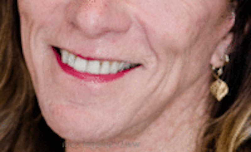 Mandible Contouring Before & After Gallery - Patient 398576 - Image 2