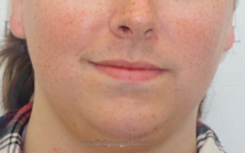 FFS Mandible Contouring Before & After Gallery - Patient 110355 - Image 1
