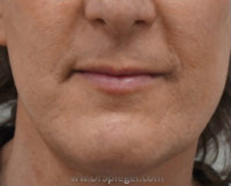 Mandible Contouring Before & After Gallery - Patient 515207 - Image 2